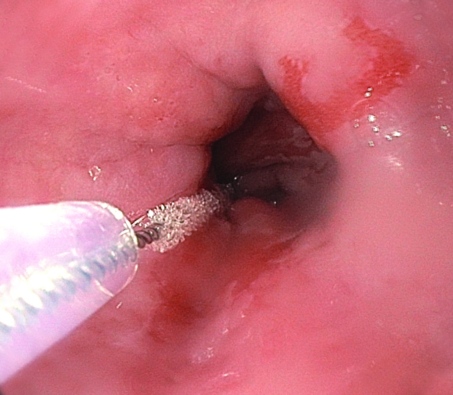 WATS3D in Endoscope of throat