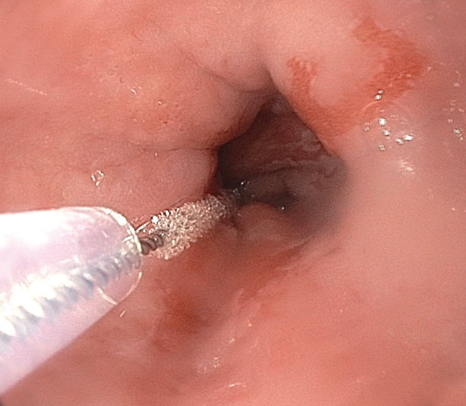 WATS3D in Endoscope of throat