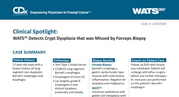 WATS<sup>3D</sup> Detects Crypt Dysplasia that was Missed by Forceps Biopsy