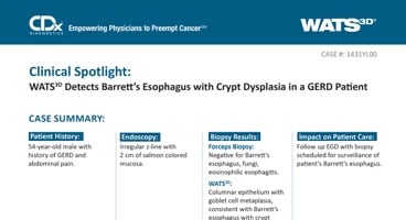 WATS<sup>3D</sup> Detects Barrett's Esophagus with Crypt Dysplasia in a GERD Patient