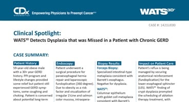 WATS<sup>3D</sup> Detects Dysplasia that was Missed in a Patient with Chronic GERD