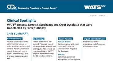 WATS<sup>3D</sup> Detects Barrett's Esophagus and Crypt Dysplasia that wereUndetected by Forceps Biopsy