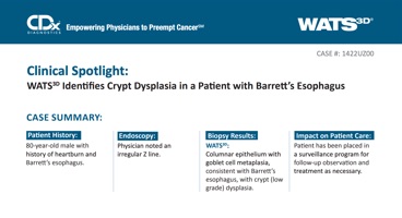 WATS<sup>3D</sup> Identifies Crypt Dysplasia in a Patient with Barrett's Esophagus