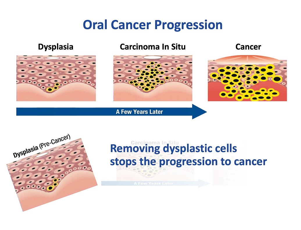 oral cancer prevention diagram 